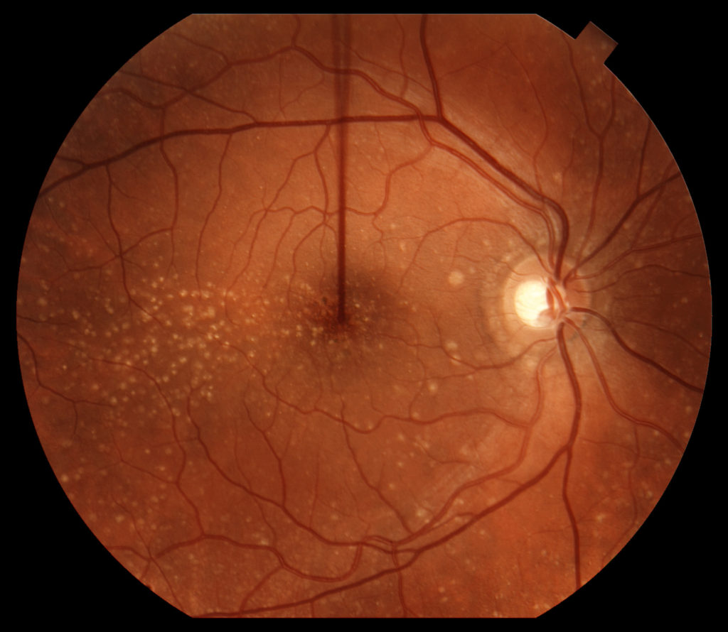 Macular Drusen Right Eye Icd 10