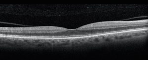 normal OCT retina scan