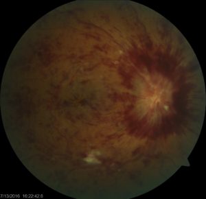 Central Retina Vein Occlusion | retinal vascular occlusions | Orange County Retina Specialist