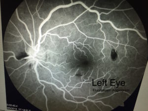 Left Eye | Fluorescein Angiogram | Shahem Kawji MD | Retina Specialist Orange County, California