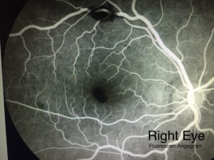 Right Eye FA | Kawji MD | Retina Specialist Orange County California