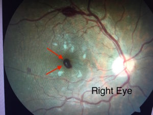 Right Eye | Shahem Kawji MD | Retina Specialist Orange County, California