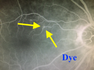 Branch Retinal Artery Occlusion | Fluorescein Angiography | Retina Specialist Orange County | Shahem Kawji MD