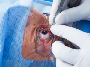 Complications of Cataract Surgery | Retina Specialist Orange County