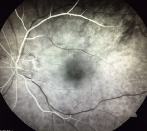 Fluorescein Angiogram Central Retinal Artery Occlusion CRAO | Shahem Kawji MD Orange County Retina Specialist