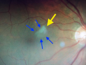 Hollenhorst Plaque Branch Retinal Artery Occlusion | Retina Specialist Orange County | Shahem Kawji MD